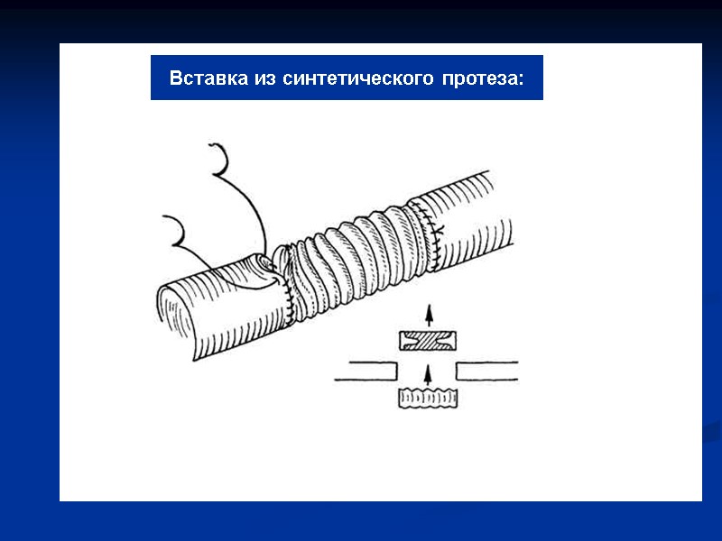 Вставка из синтетического протеза: